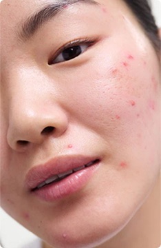 Close up of visibly reactive skin with a compromised barrier